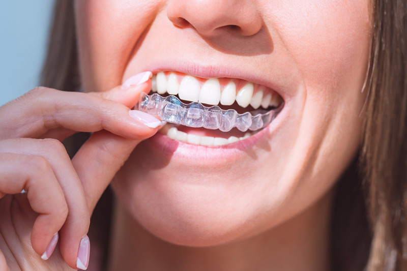 Clear Aligner Therapy in Stratford