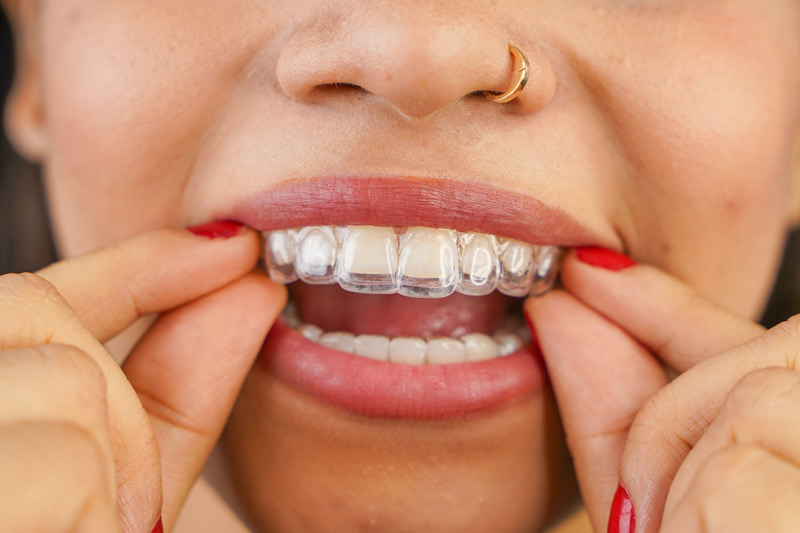 Clear Aligner Therapy in Stratford