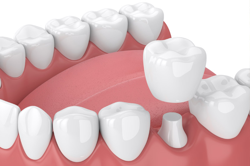 Dental Crowns in Stratford