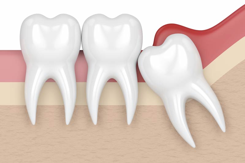 Wisdom Tooth Removal in Stratford